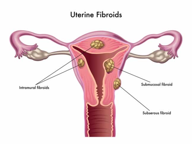 Fibroids Impact Fertility