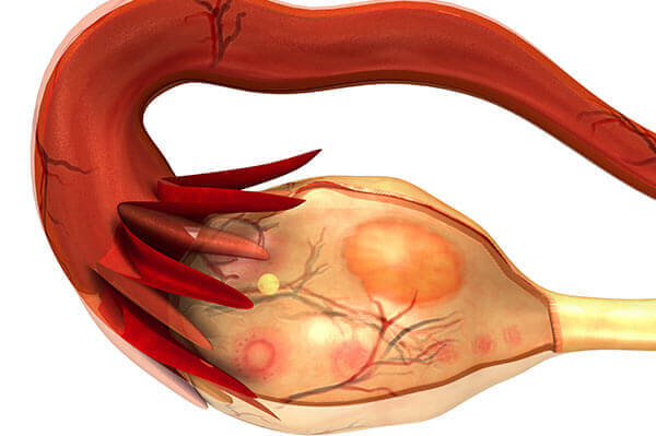 Ovulatory dysfunction