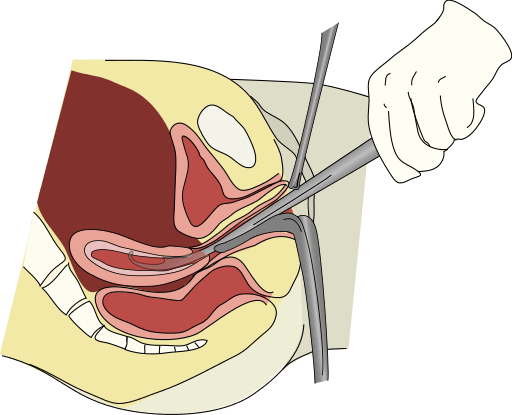 Dilation and curettage