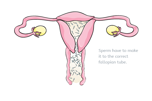 Sperm in the uterus (womb)
