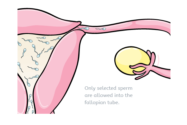 Sperm in fallopian tube