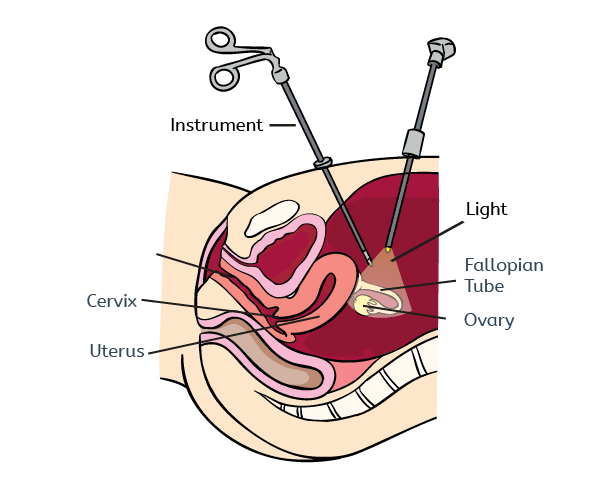 Endometriosis laparoscopy