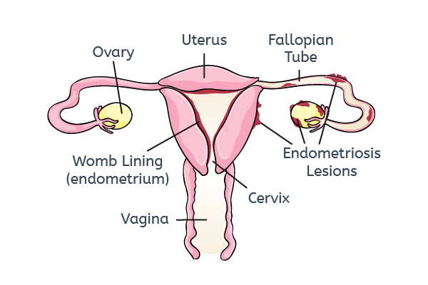 Endometriosis lesions outside uterus