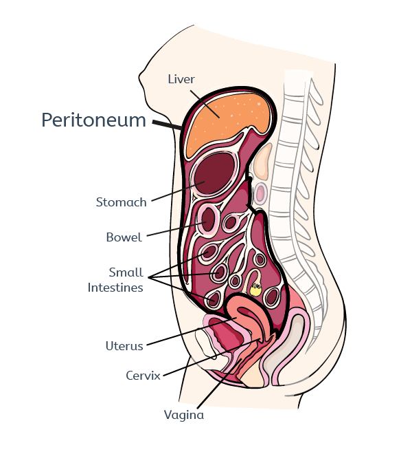 Endometriosis peritoneal cavity