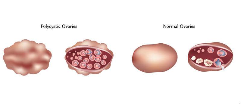 Polycystic ovary and normal ovary