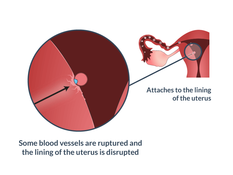 what does brown implantation bleeding look like on a pad