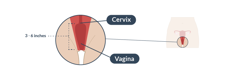 The cervix is the part of the uterus that opens into the vagina