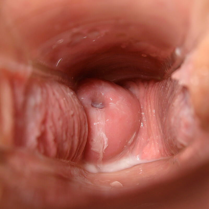 Cervix Day 24