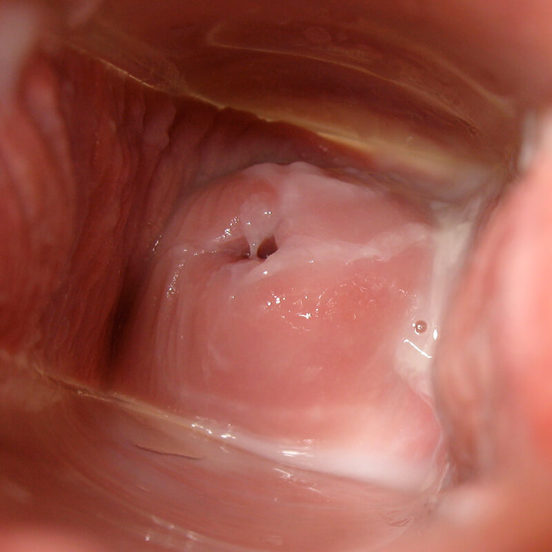 Cervix Day 26