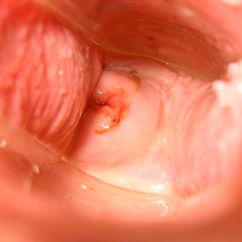 Cervix Day 33