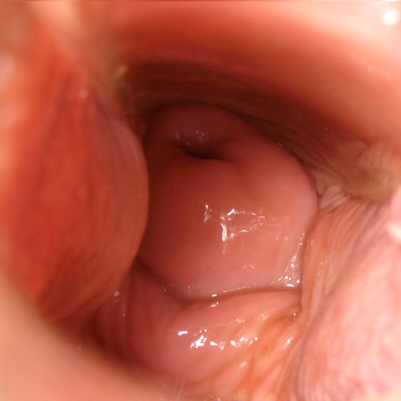 Cervix Day 5