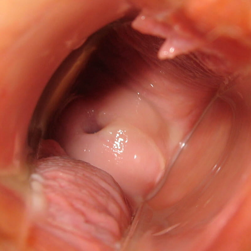 Cervix Day 6