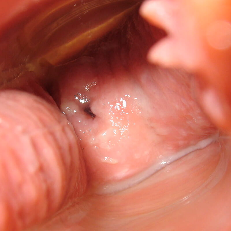 Cervix Day 9